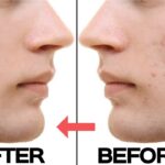 How to stop pimples coming on face